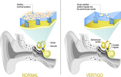 benign-paroxysmal-positional-vertigo.png